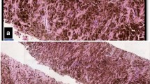 melanotic schwannoma and melanoma Intracranial Schwannomas: Rare Distinctive Tumors to Know Due to their Risk of Recurrence and Metastases Melanotic Schwannoma" (malignant melanotic nerve