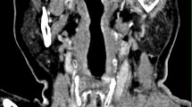 Fish Bone Neck Radiograph Fish bone migration: complications, diagnostic challenges, and ...