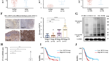 Tumor-derived lactate fuels the STAT3-LCN2 pathway to promote bladder cancer malignancy and chemoresistance - Scientific Reports