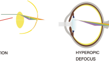 recent research suggests myopia may be caused by