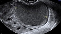 schematic representation of ectopic pregnancy