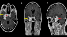 intracranial melanotic schwannoma Intracranial melanotic schwannomas: a rare variant with unusual adherent  features | Journal of Neuro-Oncology