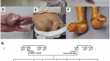 Classical-like EhlersDanlos syndrome: a clinical description of 20 newly  identified individuals with evidence of tissue fragility | Genetics in  Medicine