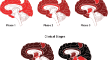 alzheimer's disease research paper topics