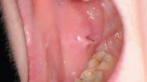 clinical presentation of oral lichen planus