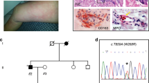 new research chronic urticaria