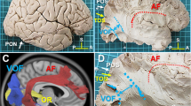 case study of occipital lobe