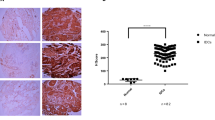 ABSTRACT Oncoprotein 18/stathmin (Op18) is a conserved cytosolic phosphoprotein that regulates microtubule dynamics. The microtubule destabilizing activity is regulated by phosphorylation, mediated by both growth factor stimulated- and cell-cycle regulating kinases. The protein is highly expressed in a variety of human malignancies. In human breast carcinoma, Op18 has previously been shown to be up-regulated in a subset of the tumours, however, no correlation with clinicopathologic characteristics has been reported so far. In the present study we have examined Op18 protein expression by quantitative Western blot analysis in a panel of 151 semi-consecutive breast carcinoma samples. Op18 levels were negatively correlated with oestrogen receptor (OR) expression and positively correlated with a high fraction of aneuploid cells, proliferation measured by proliferating cell nuclear antigen (PCNA) expression, tumour size and histopathologic grade. Taken together, and in contrast to what has been previously reported, the present study shows that high Op18 expression correlates with general predictive factors and is not restricted to a specific sub-group of breast carcinoma. © 2000 Cancer Research Campaign SIMILAR CONTENT BEING VIEWED BY OTHERS HIGH FORMIN BINDING PROTEIN 17 (FBP17) EXPRESSION INDICATES POOR DIFFERENTIATION AND INVASIVENESS OF DUCTAL CARCINOMAS Article Open access 14 July 2020 SURVIVAL ANALYSIS IN BREAST CANCER USING PROTEOMIC DATA FROM FOUR INDEPENDENT DATASETS Article Open access 18 August 2021 HISTOLOGIC AND GENOMIC FEATURES OF BREAST CANCERS WITH ALTERATIONS AFFECTING THE SWI/SNF (SMARC) GENES Article 02 June 2021 ARTICLE PDF CHANGE HISTORY * _ 16 NOVEMBER 2011 This paper was modified 12 months after initial publication to switch to Creative Commons licence terms, as noted at publication _ REFERENCES * Ahn J, Murphy M, Kratowicz S, Wang A, Levine AJ and George DL (1999) Down regulation of the stathmin/Op18 and FKBP25 genes following p53 induction. _Oncogene_ 18: 5954–5958 Article  CAS  Google Scholar  * Balogh A, Mege RM Sobel A (1996) Cell density dependent expression of stathmin in C2 myoblasts in culture. _Exp Cell Res_ 224: 8–15 Article  CAS  Google Scholar  * Belmont LD Mitchison TJ (1996) Identification of a protein that interacts with tubulin dimers and increases the catastrophe rate of microtubules. _Cell_ 84: 623–631 Article  CAS  Google Scholar  * Beretta L, Dobransky T Sobel A (1993) Multiple phosphorylation of stathmin. Identification of four sites phosphorylated in intact cells and in vitro by cyclic AMP-dependent protein kinase and p34cdc2. _J Biol Chem_ 268: 20076–20084 CAS  PubMed  Google Scholar  * Bièche I, Lachkar S, Becette V, Cifuentes-Diaz C, Sobel A, Lidereau R Curmi PA (1998) Overexpression of the stathmin gene in a subset of human breast cancer. _Br J Cancer_ 78: 701–709 Article  Google Scholar  * Brattsand G, Roos G, Marklund U, Ueda H, Landberg G, Nånberg E, sideras P Gullberg M (1993) Quantitative analysis of the expression and regulation of an activation-regulated phosphoprotein (oncoprotein 18) in normal and neoplastic cells. _Leukemia_ 7: 569–579 CAS  PubMed  Google Scholar  * Brattsand G, Marklund U, Nylander K, Roos G Gullberg M (1994) Cell-cycle-regulated phosphorylation of oncoprotein 18 on Ser16, Ser25 and Ser 38. _Eur J Biochem_ 220: 359–368 Article  CAS  Google Scholar  * Burton K (1968) Determination of DNA concentrations with diphenylamine. In: _Methods in enzymology_ 12, Grossman L and Moldave K (eds), pp. 163–166, Academic Press: New York Google Scholar  * Cailleau R, Olivé M Cruciger QVJ (1978) Long-term human breast carcinoma cell lines of metastatic origin: Preliminary characterization. _In Vitro_ 14: 911–915 Article  CAS  Google Scholar  * Caleffi M, Teague MW, Jensen RA, Vnencak-Jones CL, Dupont WD Parl FF (1994) P53 gene mutations and steroid receptor status in breast cancer. _Cancer_ 73: 2147–2156 Article  CAS  Google Scholar  * Cassimeris L (1999) Accessory protein regulation of microtubule dynamics throughout the cell cycle. _Curr Opin Cell Biol_ 11: 134–141 Article  CAS  Google Scholar  * Cooper HL, Fulder R, McDuffie E Braverman R (1990) A specific defect of prosolin phosphorylation in T cell leukemic lymphoblasts is associated with impaired down-regulation of DNA synthesis. _J Immunol_ 145: 1205–1213 CAS  PubMed  Google Scholar  * Doye V, Soubrier F, Bauw G, Boutterin MC, Beretta L, Koppel J, Vandekerckhove J Sobel A (1989) A single cDNA encodes two isoforms of stathmin, a developmentally regulated neuron-enriched phosphoprotein. _J Biol Chem_ 264: 12134–12137 CAS  PubMed  Google Scholar  * Elston CW Ellis IO (1991) Pathological prognostic factors in breast cancer, I. The value of histological grade in breast cancer: experience from a large study with long-term follow-up. _Histopathology_ 19: 403–410 Article  CAS  Google Scholar  * Fechter GE, Mueller A, Kaufmann M, Haag D, Born IA, Abel U, Klinga K, Kubli F Goerttler K (1988) Correlation of DNA flow cytometric results and other prognostic factors in primary breast cancer. _Int J Cancer_ 41: 823–828 Article  Google Scholar  * Fogh J, Wright WC Loveless JD (1977) Absence of HeLa cell contamination in 169 cell lines derived from human tumours. _J Natl Cancer Inst_ 58: 209–214 Article  CAS  Google Scholar  * Friedrich B, Grönberg H, Landström M, Bergh A Gullberg M (1995) Differentiation-stage specific expression of oncoprotein 18 in human and rat prostatic adenocarcinoma. _Prostate_ 27: 102–109 Article  CAS  Google Scholar  * Ghosh PK, Anderson J, Cohen N, Takeshita K, Atweh GF Lebowitz P (1993) Expression of the leukemia-associated gene, p18, in normal and malignant tissues; inactivation of expression in a patient with cleaved B-cell lymphoma/leukemia. _Oncogene_ 8: 2869–2872 CAS  PubMed  Google Scholar  * Gullberg M, Noreus K, Brattsand G, Friedrich B Shingler V (1990) Purification and characterization of a 19-kilodalton intracellular protein. An activation-regulated putative protein kinase C substrate of T lymphocytes. _J Biol Chem_ 265: 17499–17505 CAS  PubMed  Google Scholar  * Hailat N, Strahler JR, Melhem RF, Zhu XX, Brodeur G, Seeger RC, Reynolds CP Hanash SM (1990) N-myc gene amplification in neuroblastoma isassociated with altered phosphorylation of a proliferation related polypeptide (Op18). _Oncogene_ 5: 1615–1618 CAS  PubMed  Google Scholar  * Hanash SM, Strahler JR, Kuick R, Chu EH Nichols D (1988) Identification of a polypeptide associated with the malignant phenotype in acute leukemia. _J Biol Chem_ 263: 12813–12815 CAS  PubMed  Google Scholar  * Jeha S, Luo X, Beran M, Kantarjian H Atweh GF (1996) Antisense RNA inhibition of phosphoprotein p18 expression abrogates the transformed phenotype of leukemic cells. _Cancer Res_ 56: 1445–1450 CAS  PubMed  Google Scholar  * Keydar I, Chen L, Karby S, Weiss FR, Delarea J, Radu M, Chaitcik S Brenner HJ (1979) Establishment and characterization of a cell line of human breast carcinoma origin. _Eur J Cancer_ 15: 659–670 Article  CAS  Google Scholar  * Koppel J, Loyer P, Maucuert A, Rehák P, Manceau V, Guguen-Guillouzo C Sobel A (1993) Induction of stathmin expression during liver regeneration. _FEBS Lett_ 331: 65–70 Article  CAS  Google Scholar  * Labdon JE, Nieves E Schubart UK (1992) Analysis of phosphoprotein p19 by liquid chromatography/mass spectrometry. Identification of two proline-directed serine phosphorylation sites and a blocked amino terminus. _J Biol Chem_ 267: 3506–3513 CAS  PubMed  Google Scholar  * Larsson N, Marklund U, Melander Gradin H, Brattsand G Gullberg M (1997) Control of microtubule dynamics by oncoprotein 18: Dissection of the regulatory role of multisite phosphorylation during mitosis. _Mol Cell Biol_ 17: 5530–5539 Article  CAS  Google Scholar  * Lawler S (1998) If you need a shrink try stathmin/Op18. _Curr Biol_ 8: 212–214 Article  Google Scholar  * Leighton IA, Curmi P, Campbell DG, Cohen P Sobel A (1993) The phosphorylation of stathmin by MAP kinase. _Mol Cell Biochem_ 127–128: 151–156 Article  Google Scholar  * Lengauer C, Kinzler KW Vogelstein B (1998) Genetic instabilities in human cancers. _Nature_ 396: 643–649 Article  CAS  Google Scholar  * Luo X, Mookerjee B, Ferrari A, Mistry S Atweh GF (1994) Regulation of phosphoprotein p18 in leukemic cells. Cell cycle regulated phosphorylation by p34cdc2kinase. _J Biol Chem_ 269: 10312–10318 CAS  PubMed  Google Scholar  * Marklund U, Brattsand G, Osterman O, Ohlsson PI Gullberg M (1993 a) Multiple signal transduction pathways induce phosphorylation of serine 16, 25, and 38 of oncoprotein 18 in T lymphocytes. _J Biol Chem_ 268: 25671–25680 CAS  PubMed  Google Scholar  * Marklund U, Brattsand G, Shingler V Gullberg M (1993 b) Serine 25 of oncoprotein 18 is a major cytosolic target for the mitogen-activated protein kinase. _J Biol Chem_ 268: 15039–15047 CAS  PubMed  Google Scholar  * Marklund U, Larsson N, Brattsand G, Osterman Ö, Chatila TA Gullberg M (1994) Serine 16 of oncoprotein 18 is a major cytosolic target for the Ca2+/calmodulin-dependent kinase-Gr. _Eur J Biochem_ 225: 53–60 Article  CAS  Google Scholar  * Marklund U, Larsson N, Melander Gradin H, Brattsand G Gullberg M (1996) Oncoprotein 18 is a phosphporylation-responsive regulator of microtubule dynamics. _EMBO J_ 15: 5290–5298 Article  CAS  Google Scholar  * McNally FJ (1999) Controlling split ends. _Curr Biol_ 9: 274–276 Article  Google Scholar  * Melander Gradin H, Marklund U, Larsson N, Chatila TA Gullberg M (1997) Regulation of microtubule dynamics by Ca2+/calmodulin-dependent kinase IV/Gr-dependent phosphorylation of oncoproten 18. _Mol Cell Biol_ 17: 3459–3467 Article  CAS  Google Scholar  * Melander Gradin H, Larsson N, Marklund H Gullberg M (1998) Regulation of Microtubule dynamics by extracellular signals: cAMP-dependent protein kinase switches off the activity of oncoprotein 18 in intact cells. _J Cell Biol_ 140: 131–141 Article  Google Scholar  * Meyer JS Province MA (1994) S-phase fraction and nuclear size in long term prognosis of patients with breast cancer. _Cancer_ 74: 2287–2299 Article  CAS  Google Scholar  * Murphy M, Ahn J, Walker KK, Hoffman WH, Evans RM, Levine AJ George DL (1999) Transcriptional repression by wild-type p53 utilizes histone deacetylases, mediated by interaction with mSin3a. _Genes Dev_ 13: 2490–2501 Article  CAS  Google Scholar  * Nielsen NH, Arnerlöv C, Emdin SO Landberg G (1996) Cyclin E overexpression, a negative prognostic factor in breast cancer with strong correlation to ostrogen receptor status. _Br J Cancer_ 74: 874–880 Article  CAS  Google Scholar  * Nylander K, Marklund U, Brattsand G, Gullberg M Roos G (1995) Immunohistochemical detection of oncoprotein 18 (Op18) in malignant lymphomas. _Histochem J_ 27: 155–160 Article  CAS  Google Scholar  * Roos G, Brattsand G, Landberg G, Marklund U Gullberg M (1993) Expression of oncoprotein 18 in human leukemias and lymphomas. _Leukemia_ 7: 1538–1546 CAS  PubMed  Google Scholar  * Sadler WA, Murray LM Turner JG (1992) Minimum distinguishable difference in concentration: A clinically oriented translation of assay precision summaries. _Clin Chem_ 38: 1773–1778 CAS  PubMed  Google Scholar  * Schubart UK, Banerjee MD Eng J (1989) Homology between the cDNAs encoding phosphoprotein p19 and SCG10 reveals a novel mammalian gene family preferentially expressed in developing brain. _DNA_ 8: 389–398 Article  CAS  Google Scholar  * Sigurdsson H, Baldetorp B, Borg Å, Dalberg M, Fernö M, Killander D Olsson H (1990) Indicators of prognosis in nod-negative breast cancer. _N Engl J Med_ 322: 1045–1053 Article  CAS  Google Scholar  * Sobel A (1991) Stathmin: a relay phosphoprotein for multiple signal transduction?. _Trends Biochem Sci_ 16: 301–305 Article  CAS  Google Scholar  * Soule HD, Vazquez J, Long A, Albert S Brennan M (1973) A human cell line from a pleural effusion derived from a breast carcinoma. _J Natl Cancer Inst_ 21: 1409–1416 Article  Google Scholar  * Vindelov LL, Christensen IJ Nissen NI (1983) A detergen-trypsin method for the preparation of nuclei for flow cytometric DNA analysis. _Cytometry_ 3: 323–327 Article  CAS  Google Scholar  * Zhang CC, Yang JM, White E, Murphy M, Levine A Hait WN (1998) The role of MAP4 expression in the sensitivity to paclitaxel and resistance to vinca alkaloids in p53 mutant cells. _Oncogene_ 16: 1617–1624 Article  CAS  Google Scholar  * Zhang CC, Yang JM, Bash-Babula J, White E, Murphy M, Levine AJ Hait NW (1999) DNA damage increases sensitivity to vinca alkaloids and decreases sensitivity to taxanes through p53-dependent repression of microtubule-associated protein 4. _Cancer Res_ 59: 3663–3670 CAS  PubMed  Google Scholar  * Zhu XX, Kozarsky K, Strahler JR, Eckerskorn C, Lottspeich F, Melhem R, Lowe J, Fox DA, Hanash SM Atweh GF (1989) Molecular cloning of a novel human leukemia-associated gene. Evidence of conservation in animal species. _J Biol Chem_ 264: 14556–14560 CAS  PubMed  Google Scholar  * Zimmerman W, Sparks CA Doxsey SJ (1999) Amorphous no longer: the centrosome comes into focus. _Curr Opin Cell Biol_ 11: 122–128 Article  CAS  Google Scholar  Download references AUTHOR INFORMATION AUTHORS AND AFFILIATIONS * Department of Clinical Chemistry, Umeå University Hospital, Umeå, S-901 85, Sweden G Brattsand Authors * G Brattsand View author publications You can also search for this author inPubMed Google Scholar RIGHTS AND PERMISSIONS From twelve months after its original publication, this work is licensed under the Creative Commons Attribution-NonCommercial-Share Alike 3.0 Unported License. To view a copy of this license, visit http://creativecommons.org/licenses/by-nc-sa/3.0/ Reprints and permissions ABOUT THIS ARTICLE CITE THIS ARTICLE Brattsand, G. Correlation of oncoprotein 18/stathmin expression in human breast cancer with established prognostic factors. _Br J Cancer_ 83, 311–318 (2000). https://doi.org/10.1054/bjoc.2000.1264 Download citation * Received: 16 December 1999 * Revised: 30 March 2000 * Accepted: 10 April 2000 * Published: 04 July 2000 * Issue Date: 01 August 2000 * DOI: https://doi.org/10.1054/bjoc.2000.1264 SHARE THIS ARTICLE Anyone you share the following link with will be able to read this content: Get shareable link Sorry, a shareable link is not currently available for this article. Copy to clipboard Provided by the Springer Nature SharedIt content-sharing initiative KEYWORDS * oncoprotein 18 * stathmin * breast cancer * oestrogen receptor * Western blot