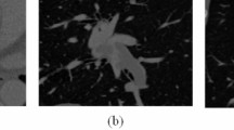 Deep learning-driven pulmonary artery and vein segmentation reveals ...