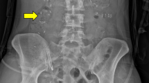 ipamorelin postoperative ileus clinical trial Multidisciplinary Management: A Narrative Review New therapeutic strategies for postoperative