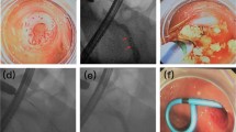 Endoscopic retrograde appendicitis therapy (ERAT) : a multicenter ...