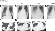 case study on pediatric pneumonia slideshare