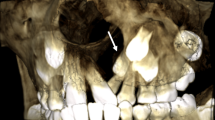 Clockwise versus counterclockwise rotation in bimaxillary surgery: 3D ...