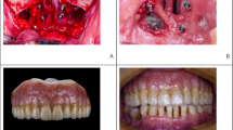 Passive fit evaluation of implant superstructures by analyzing the ...