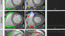 Impact of left ventricular dilatation on biventricular function and ...