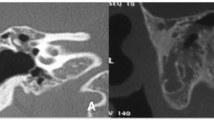 Fibrous Dysplasia of Temporal Bone with Cholesteatoma: A Case Report ...