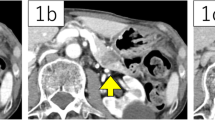 A case of solid-type pancreatic hamartoma presenting high apparent ...