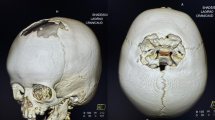 melanotic neuroectodermal tumor of infancy treatment Melanotic Neuroectodermal Tumor of Infancy of the Maxilla: A Case Report  With Review of Literature main image 1