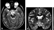 Joint radiomics and spatial distribution model for MRI-based ...