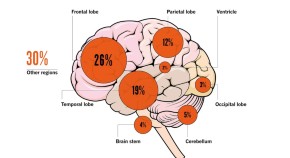 Brain cancer