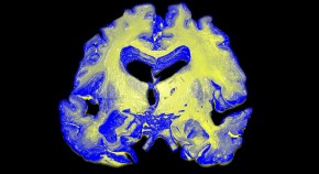 new research on causes of alzheimer's