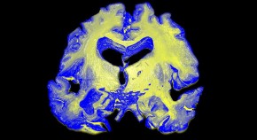 new research dementia alzheimer's