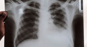 tuberculosis vaccine research articles