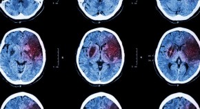 MRI brain images showing a stroke