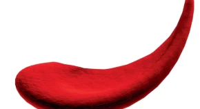A red blood cell affected by sickle cell disease.