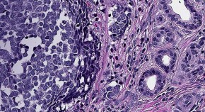 Primary cutaneous Merkel cell carcinoma