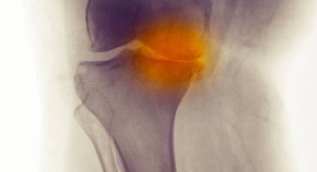 Knee x-ray of a 60 year old woman showing degenerative joint disease from osteoarthritis