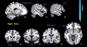 Clinical Neuroradiology Online First Articles