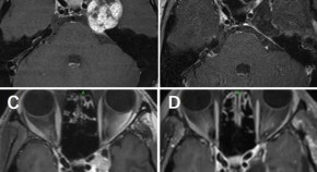 brain tumor research paper brain tumor research paper