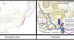 The Effect of Intra-socket Vitamin E Application on the Reduction in  Postoperative Pain and Reduction in Incidence of Dry Socket in Female  Patients: A Randomized Controlled Trial