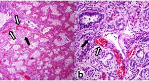 A mosaic maternal splice donor mutation in the EHMT1 gene leads to aberrant  transcripts and to Kleefstra syndrome in the offspring