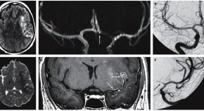 case study neurological disorders