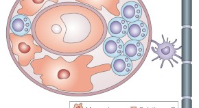 new research treatment for multiple sclerosis