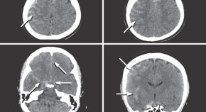 case study neurological disorders