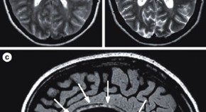 case study neurological disorders