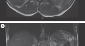 case study neurological disorders