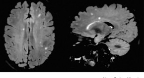 new research treatment for multiple sclerosis