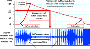 Blood pressure measurement - new insights, challenges and controversies