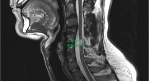 Comparison of abdominal compression devices in persons with abdominal  paralysis due to spinal cord injury