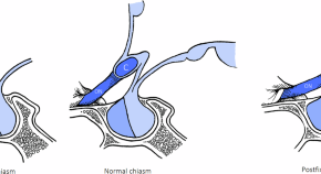 research papers on brain injury research papers on brain injury