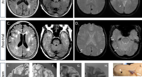 neurological disease research paper