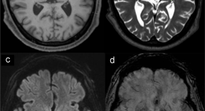 case study on parkinson's disease