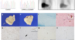 case study on parkinson's disease