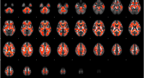 latest research into schizophrenia