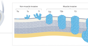 Rotator cuff tears  Nature Reviews Disease Primers