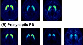 neurological disease research papers